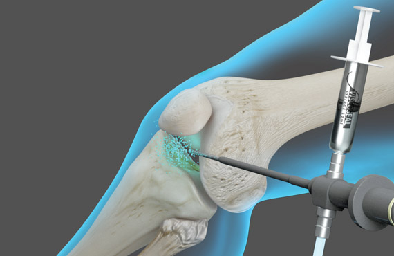 Viscoseal-syringe-knee-infographic-trb-570×370